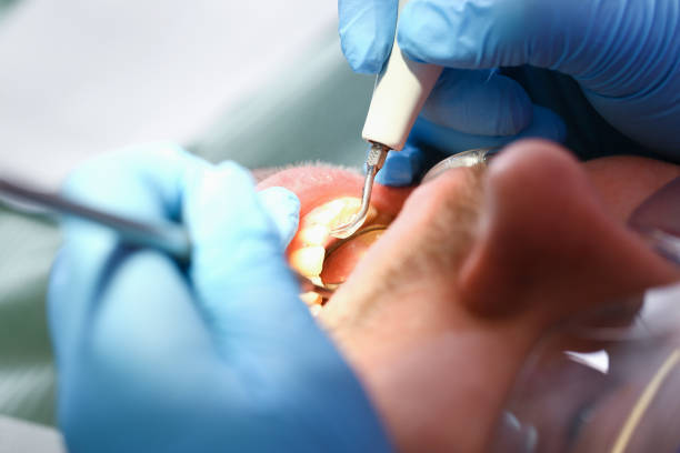 Best Emergency Tooth Extraction in Hebron, MD