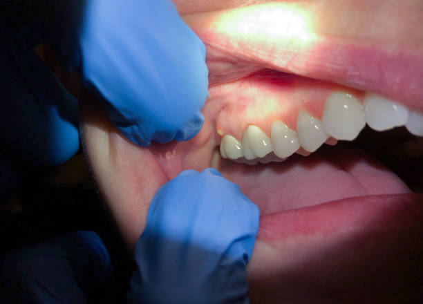 Best Emergency Tooth Extraction in Hebron, MD