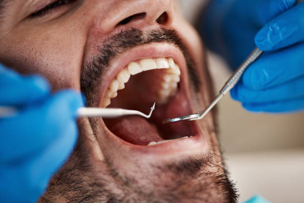 Best Emergency Root Canal Treatment in Hebron, MD