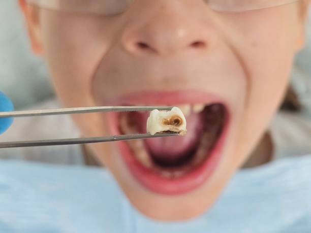 Best Emergency Broken Tooth Repair in Hebron, MD